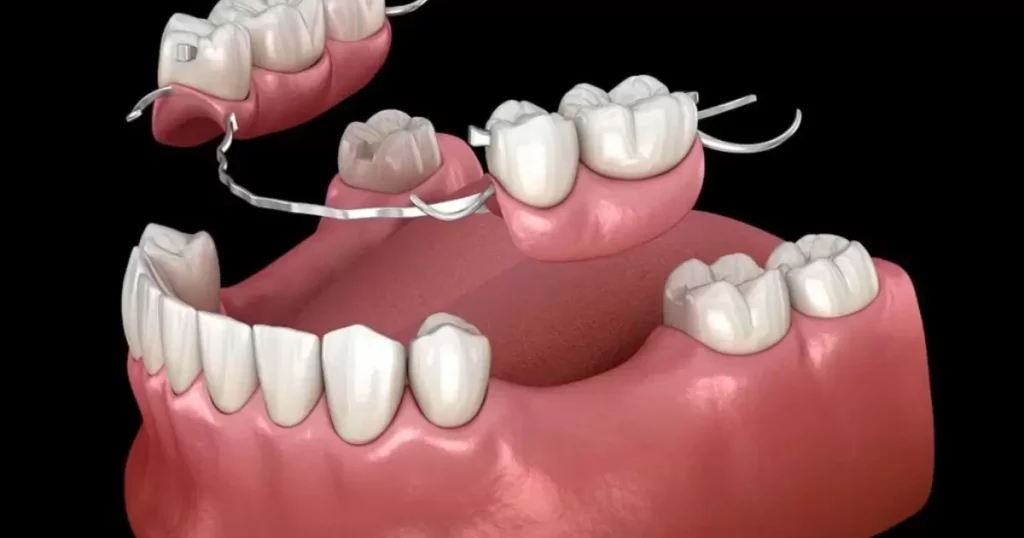 Global Perspectives on Partial Dentures