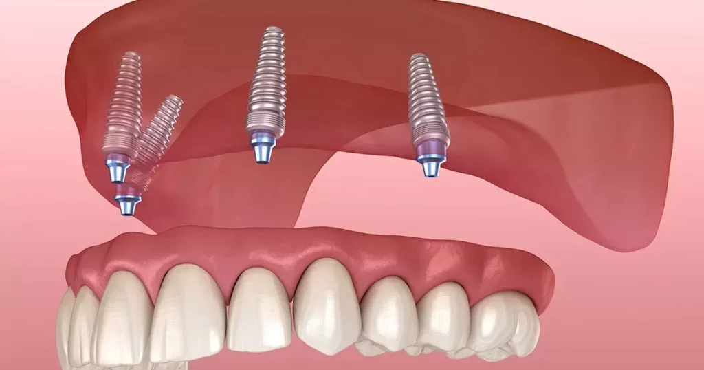 how much do snap-in denture implants cost