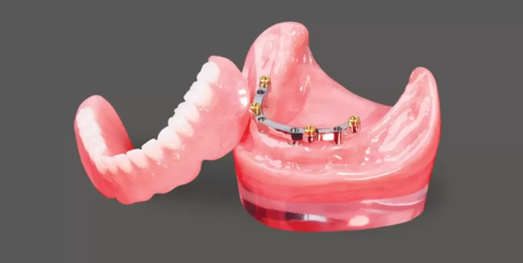 Hybrid Denture Vs Overdenture