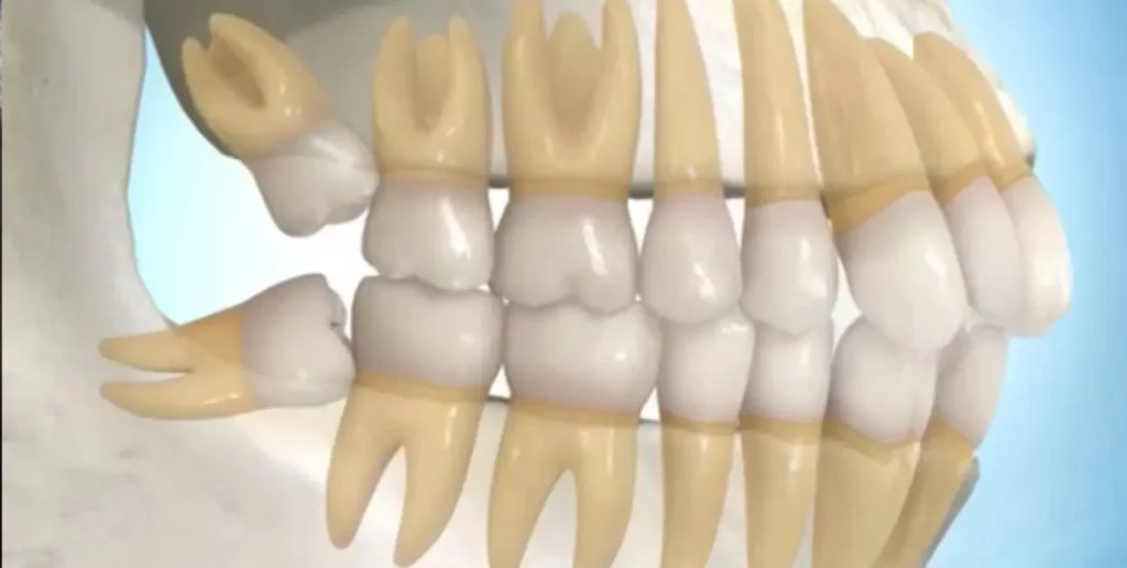 Partial Dentures For Back Teeth One Side