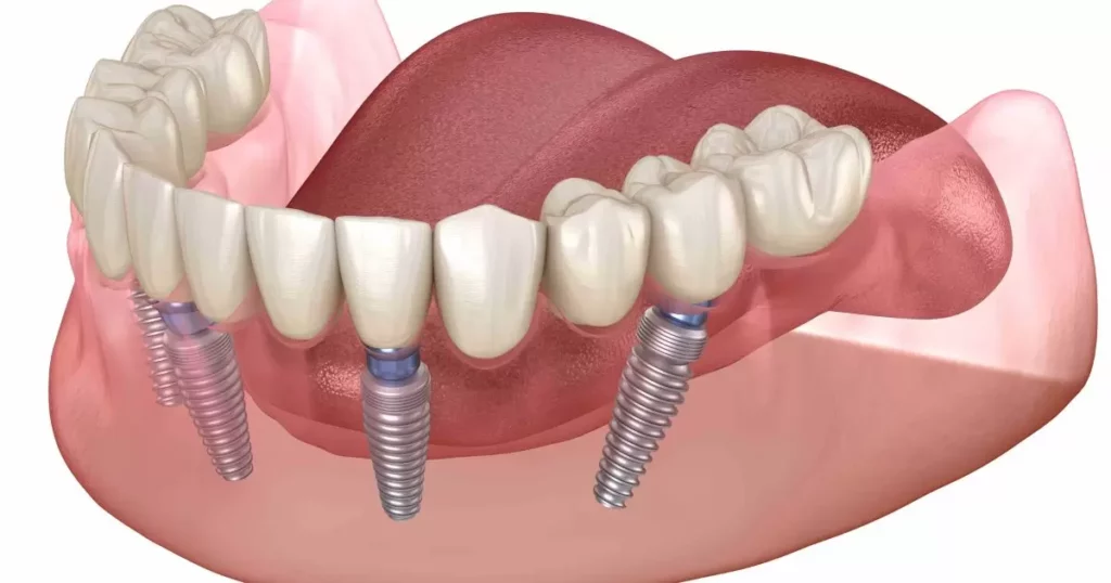 Traditional Dental Implants