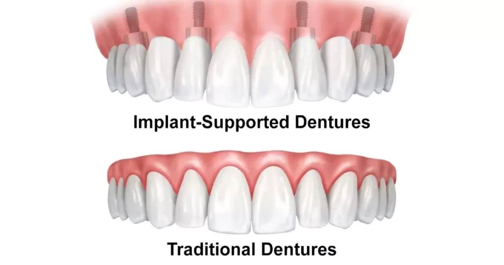 Traditional Dentures