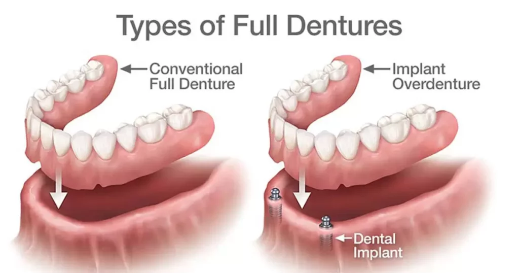 Types of Dentures