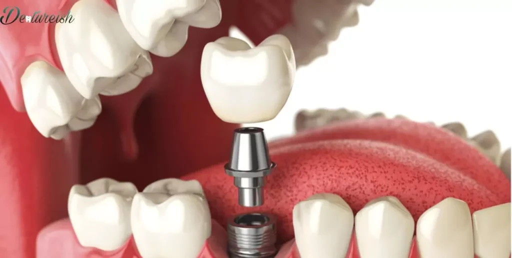 Addressing Denture Discomfort: Is Implantation the Solution?