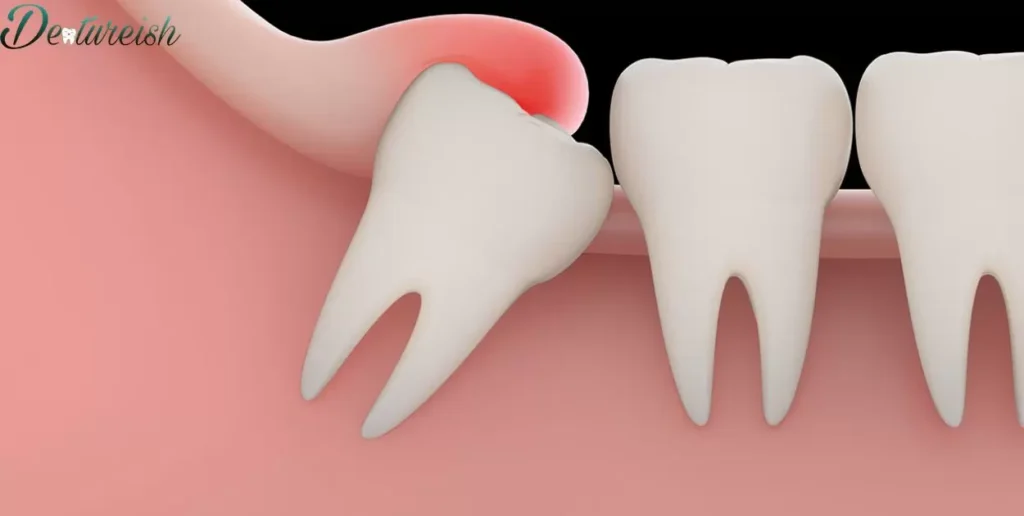 Adjacent Tooth Impact: Impact Of Veneers Vs. Dentures On Surrounding Teeth