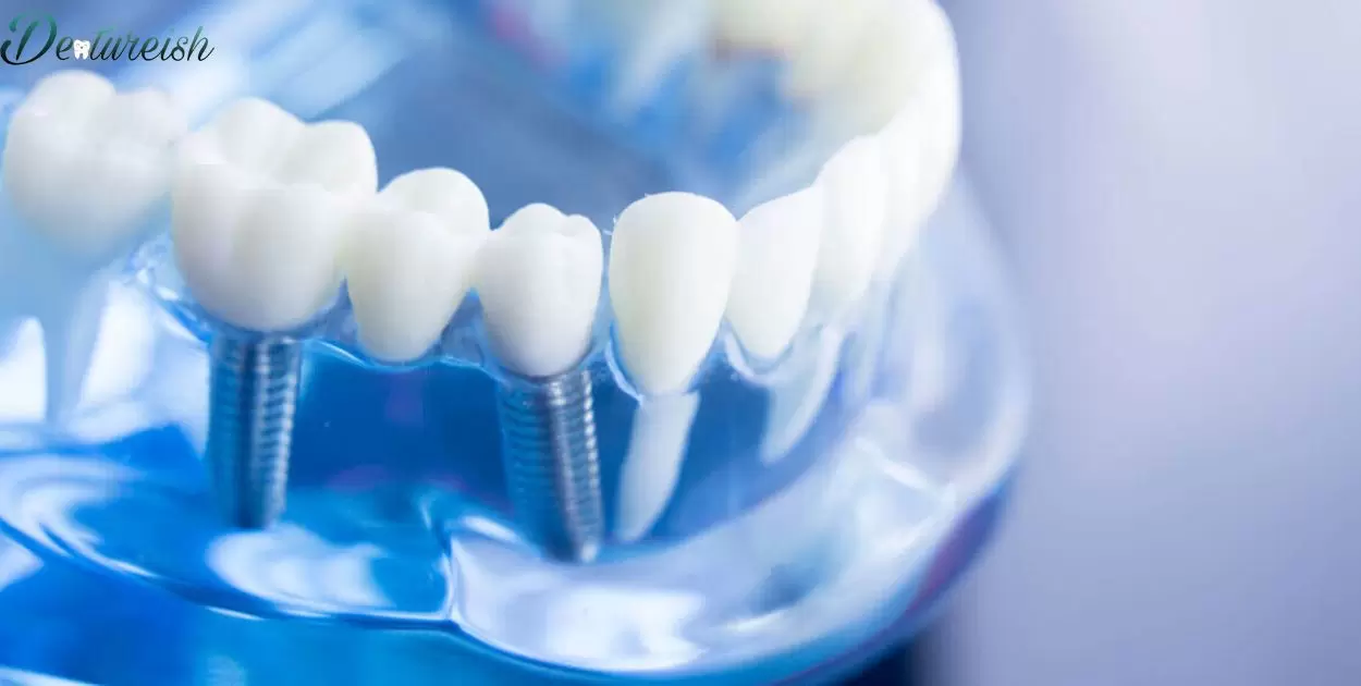 Can You Go From Dentures To Implants?