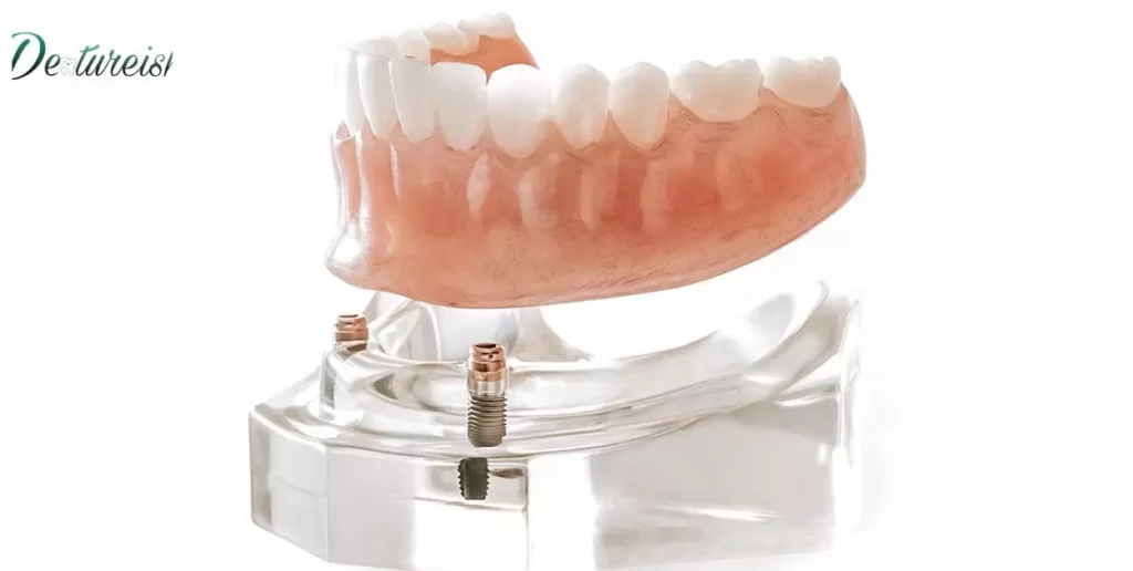 Comparing Snap-In Dentures with Other Alternatives