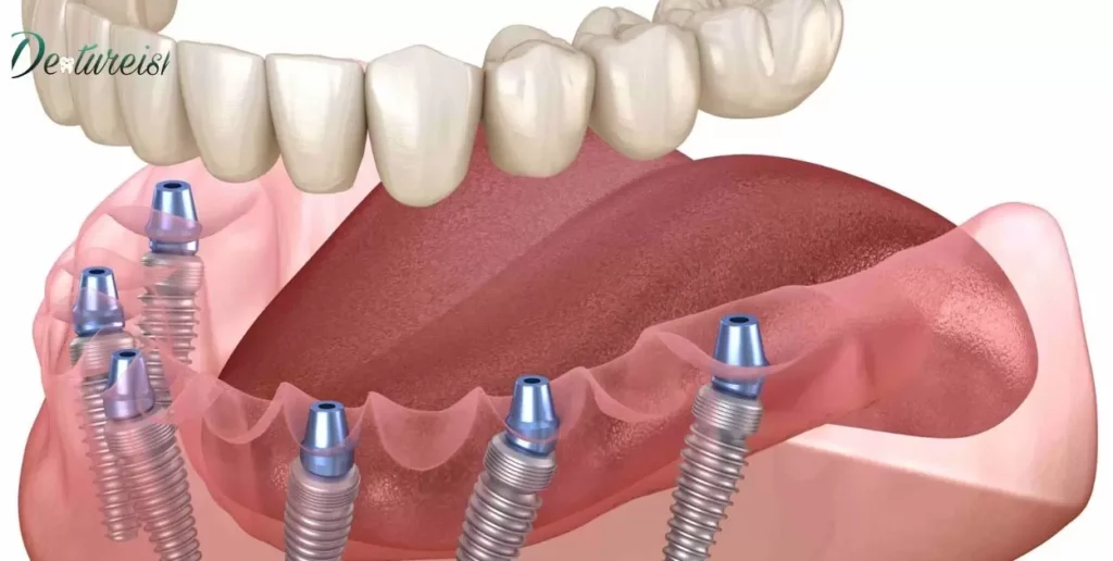 Cost Considerations for Implants After Dentures