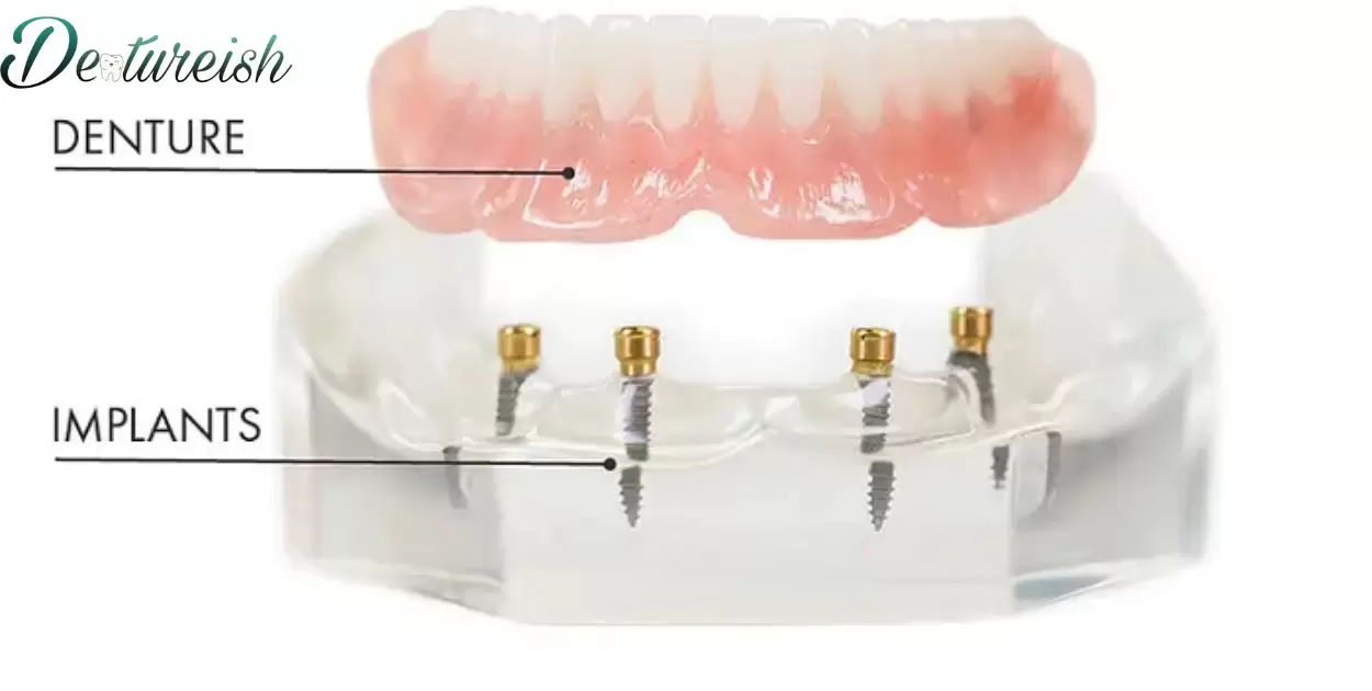 Does Dental Insurance Cover Anchored Dentures?