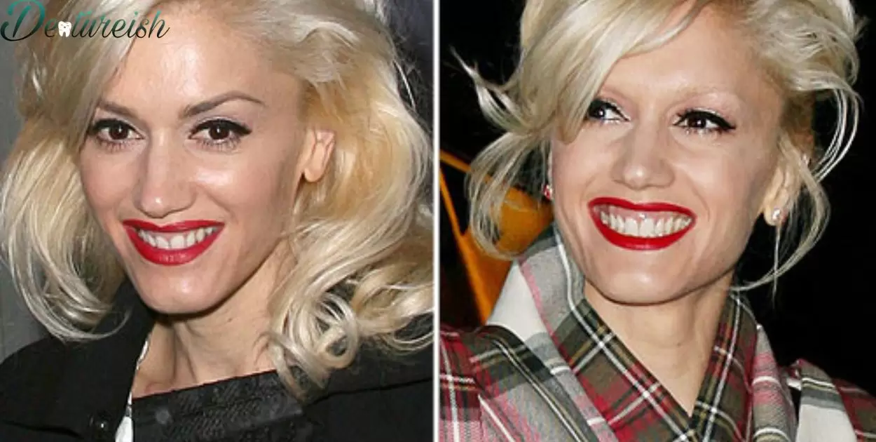 Does Gwen Stefani Have Fake Teeth?