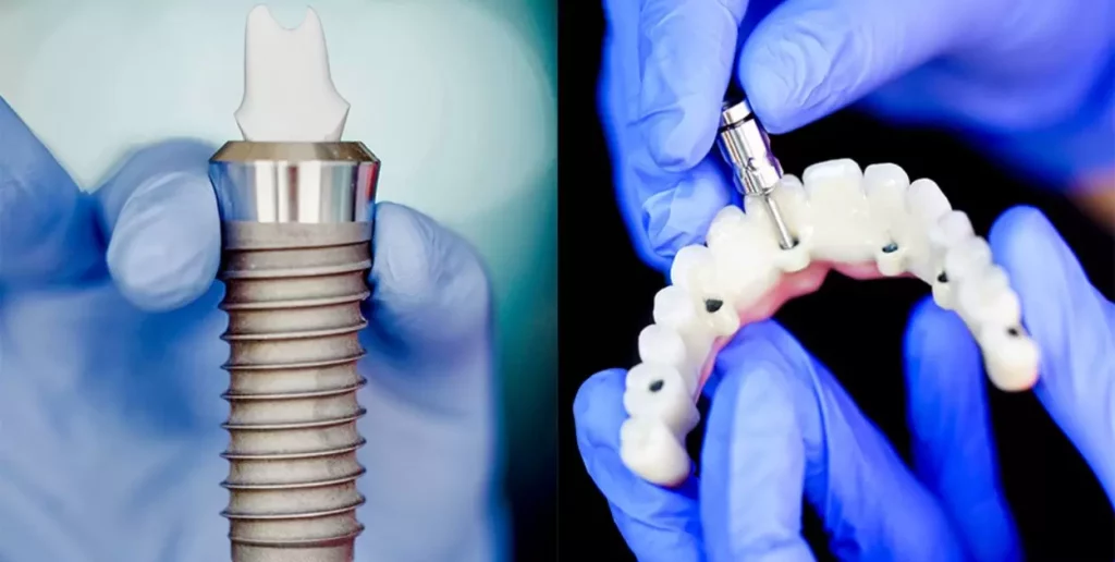 Do's and Don'ts of Cleaning Permanent Implant Dentures