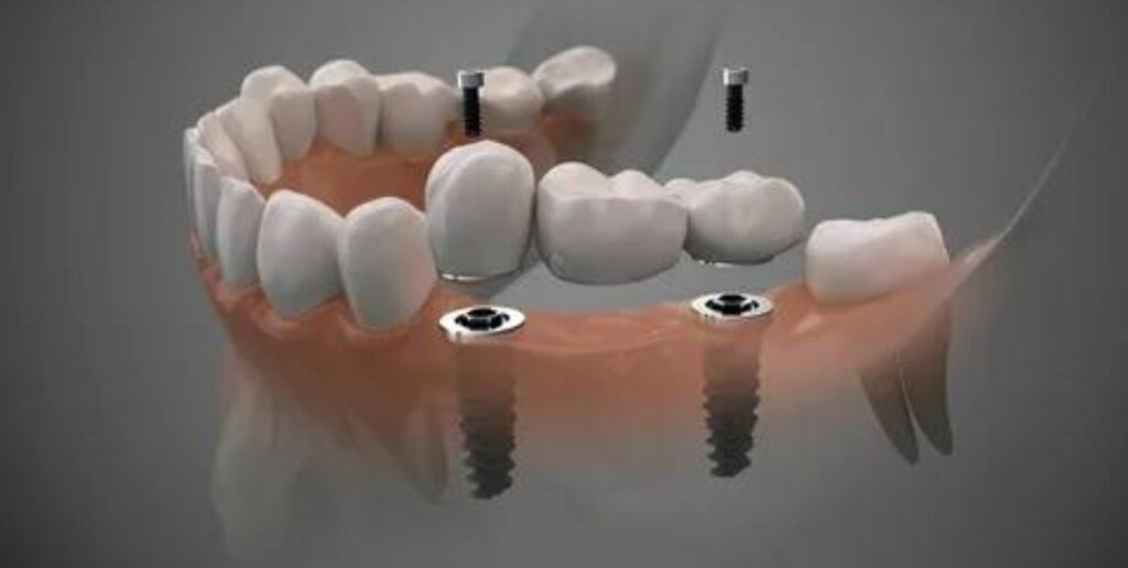 How Do I Switch from Dentures to Dental Implants?