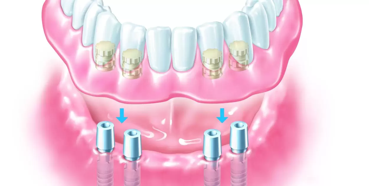 How To Get A Good Suction On Upper Dentures?