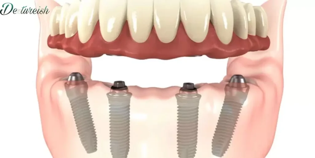 How Much Do Snap-In Denture Implants Cost