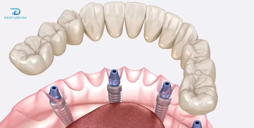 Implant-Supported Dentures for Enhanced Comfort