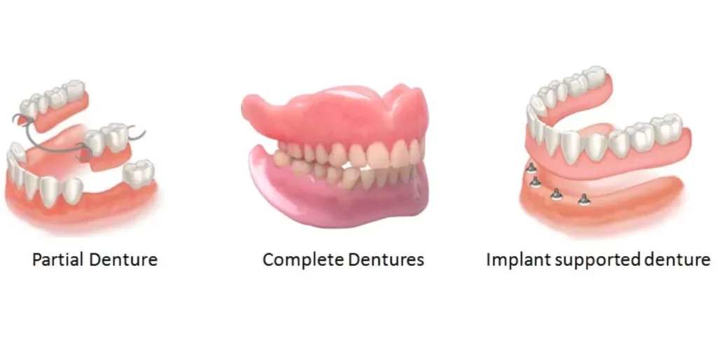 Implant-Supported Partial Denture Cost