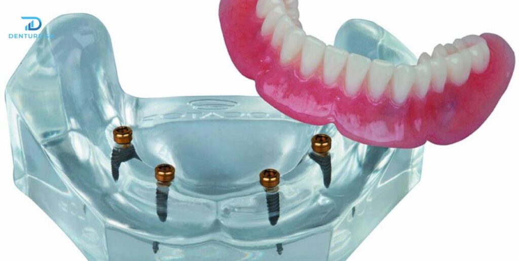 What Are Snap-In Dentures?