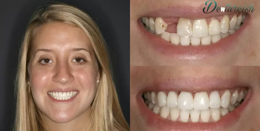 Why Do Veneers Look Like Horse Teeth Before And After