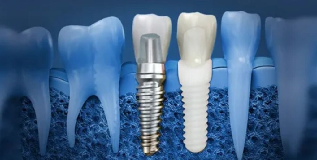 Why Switch From Dentures to Implants?