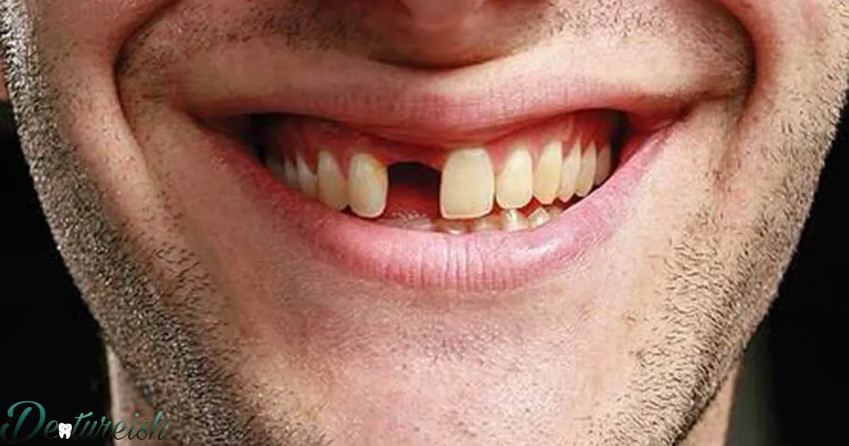 Can You Get A Single Fake Tooth?