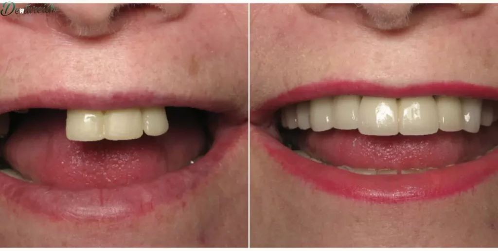 Denture Removal for Different Adhesive Types