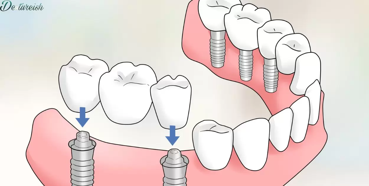 Do Bottom Dentures Stay In Place?