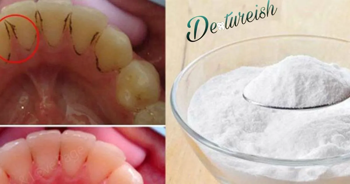 How To Remove Calcium Buildup On Dentures