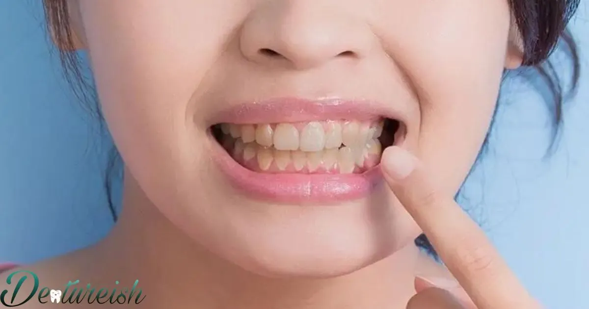 How To Remove Tartar From False Teeth?