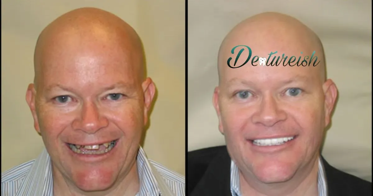 Immediate Denture Patient Cases: Before and After