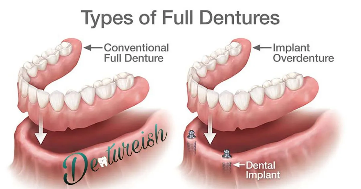 Permanent Bridge Vs Removable Partial Denture