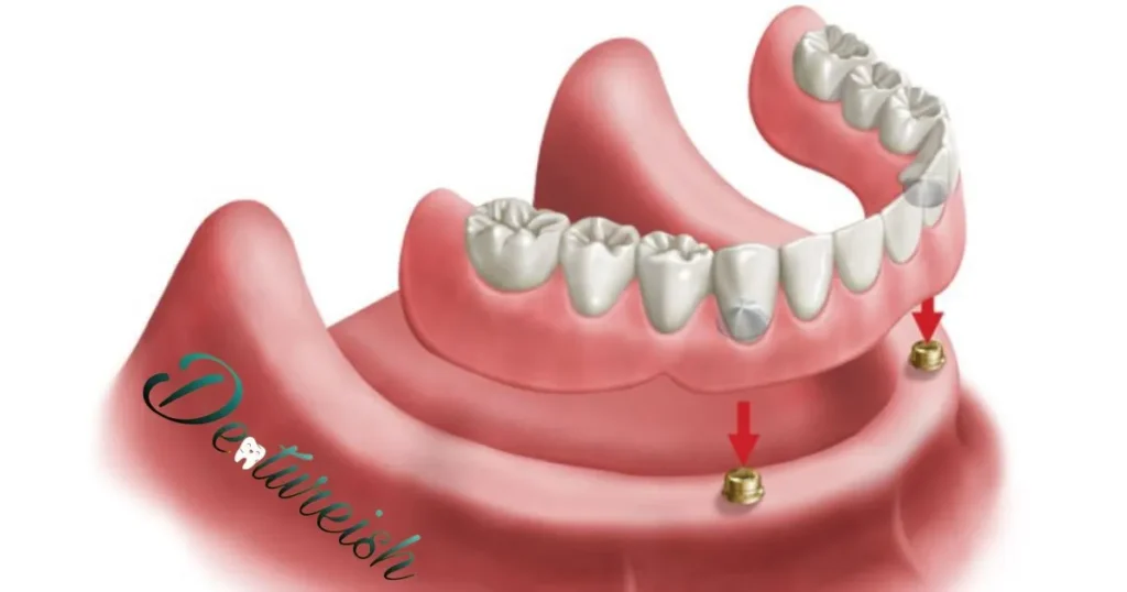 What areas of your partial denture need extra attention?