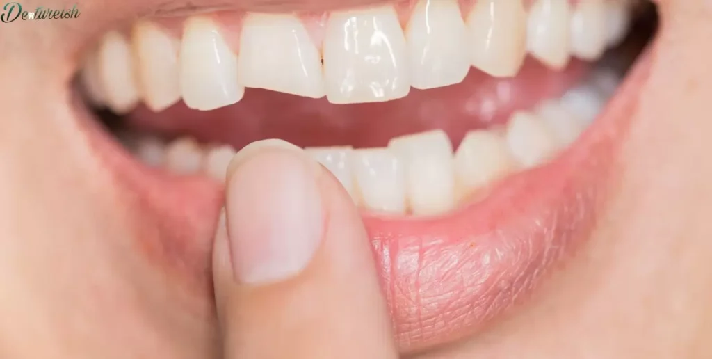 What Does Tartar Look Like On Dentures