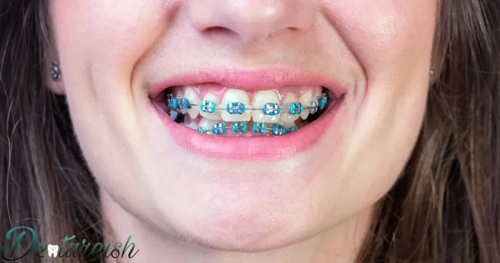 Braces Key Goals