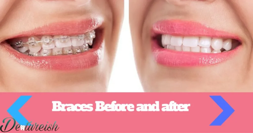 Do the forces of braces weaken tooth structures over time?