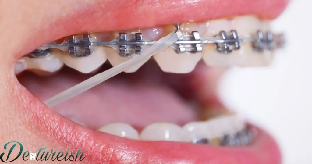 Precautions Should I Take After Reinserting Braces Key Wire