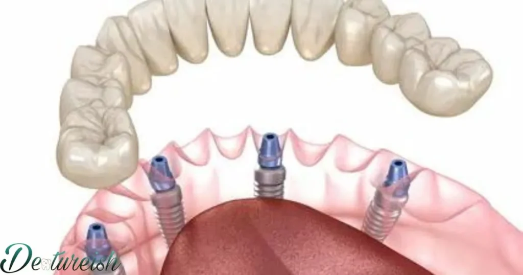 Teeth-In-A-Day Protocol For Dental Implants And Dentures