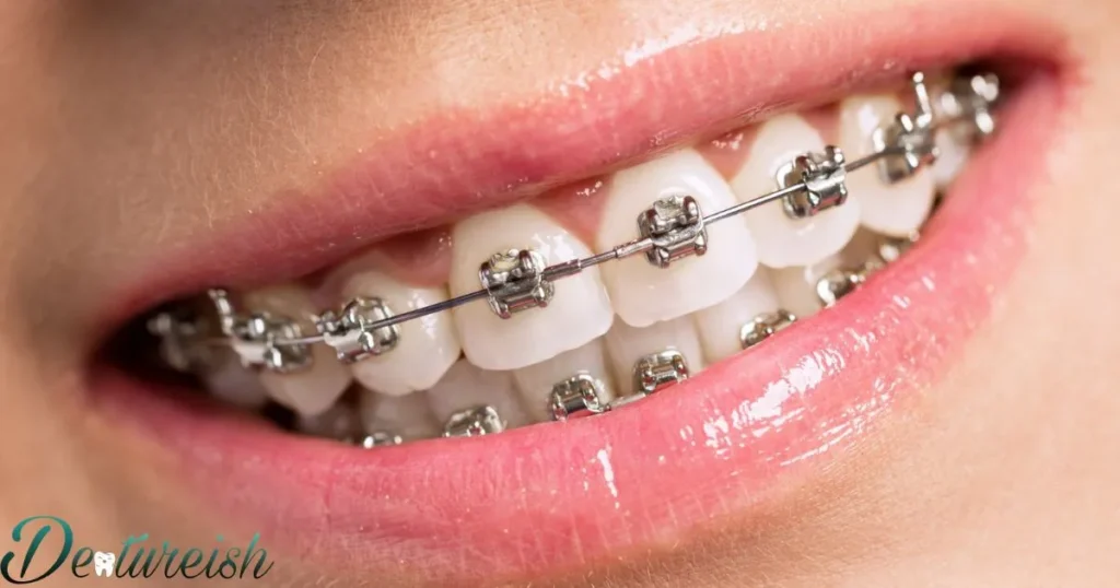 Alternatives To Metal Braces