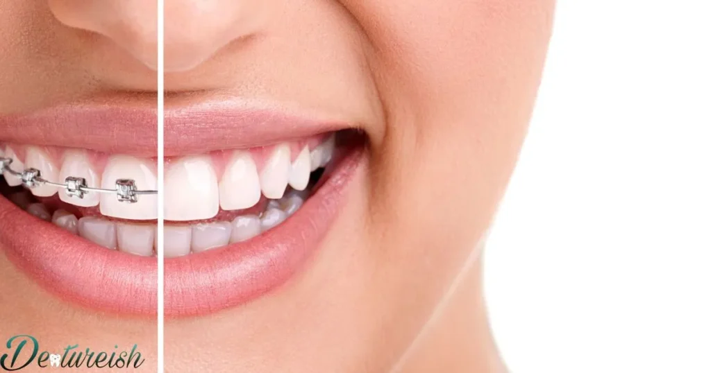 Are There Alternative Methods To Braces That Don't Use Wires Or Aligners?