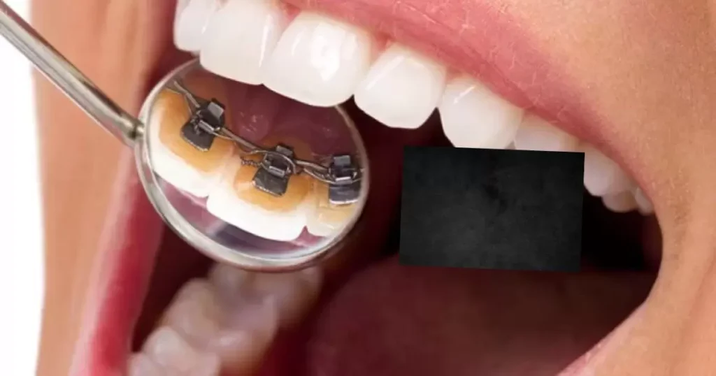 Are There Braces Hidden Behind Your Teeth?