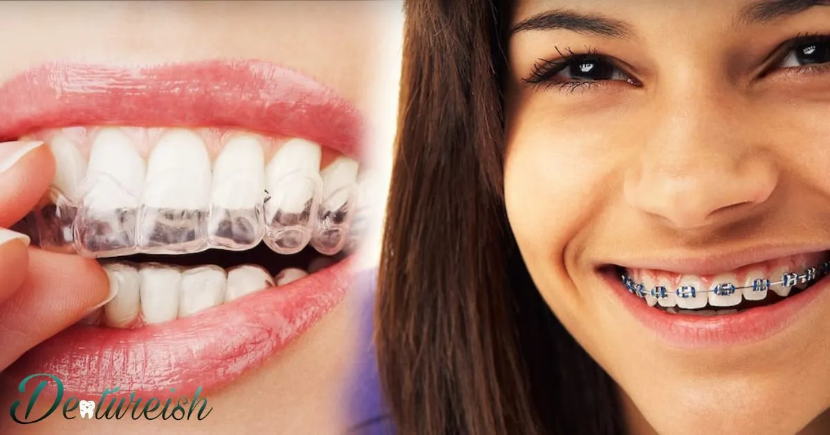 Braces Inside Teeth Vs Outside