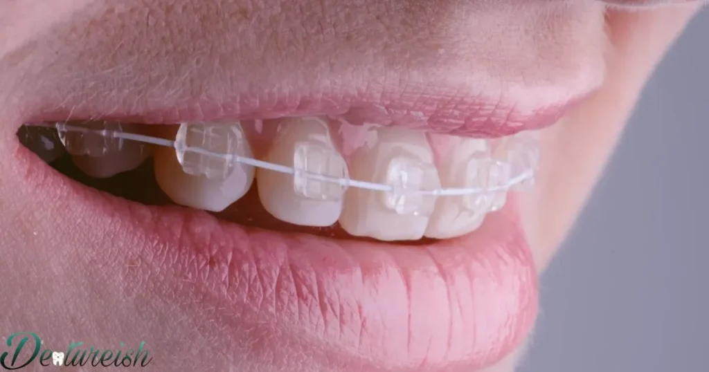 Ceramic Braces