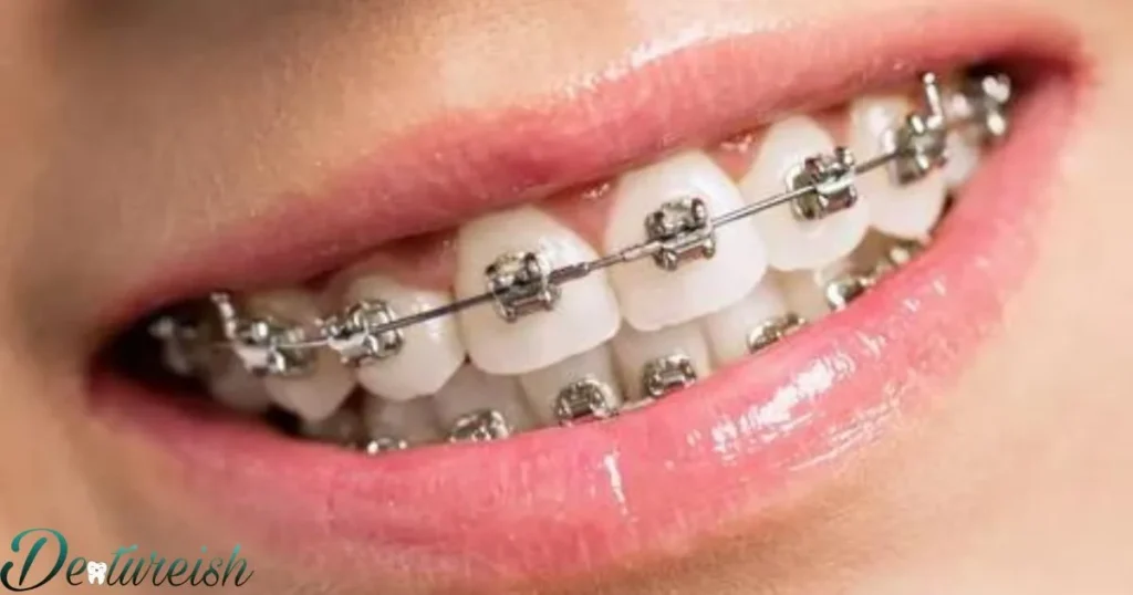 Do Ceramic Braces Work As Well As Metal Braces?