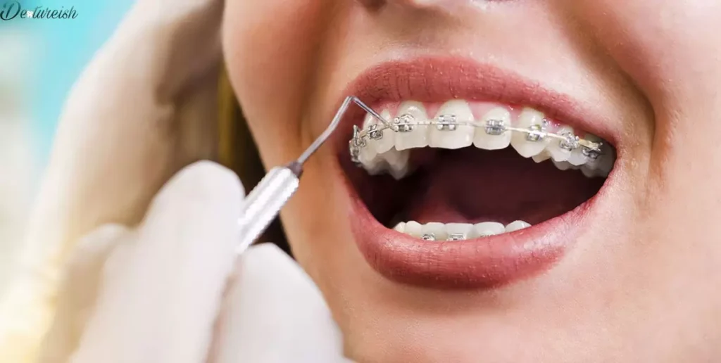 Factors To Consider When Choosing Braces