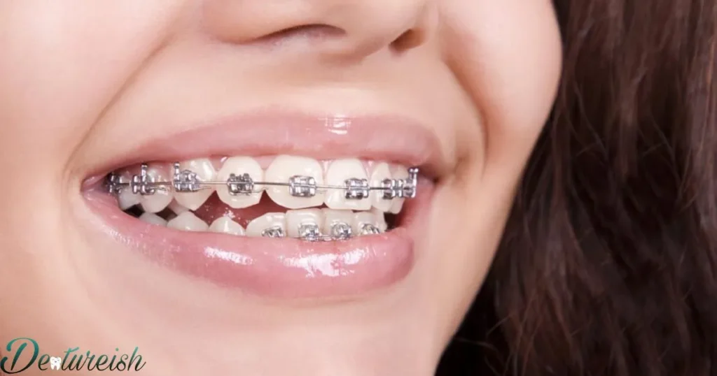 What Makes Ceramic Braces Different Than Metal Braces?